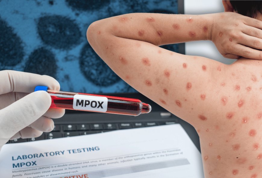 WHO Rekomendasikan Vaksinasi Terarah untuk Cegah Mpox daripada Vaksin Massal