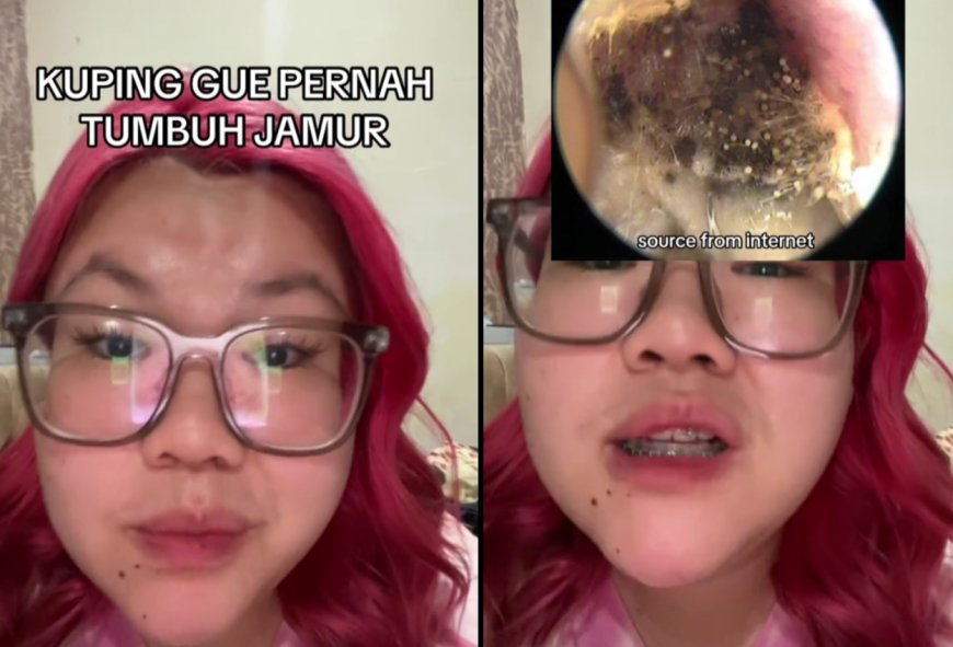 Waduh! Jamur Bersarang 2,5 Bulan di Telinga Wanita Ini