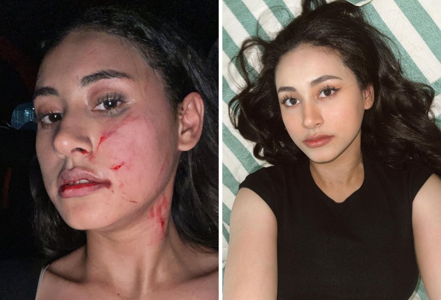 Diduga Alami KDRT, Wajah Selebgram Afifah Riyad Babak Belum dan Penuh Cakaran