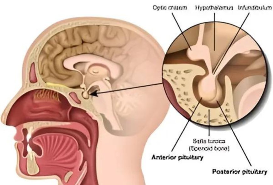 Jenis-Jenis Empty Sella Syndrome