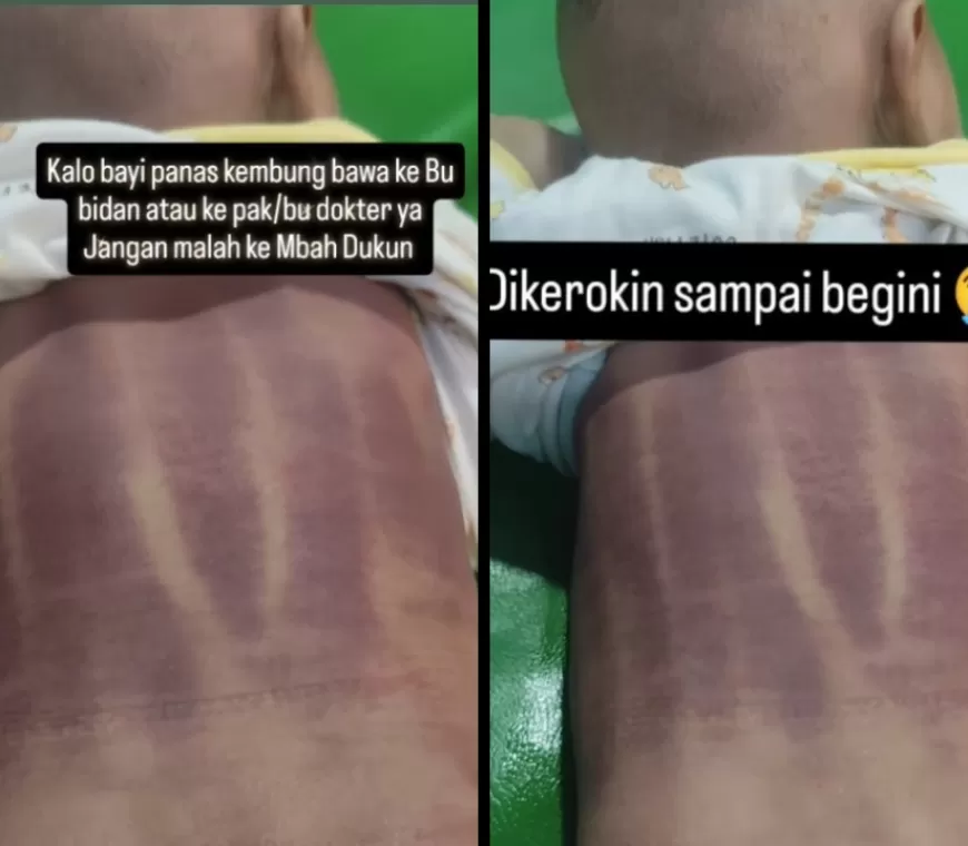 Viral Video Bayi Menangis Kesakitan Usai Dikerok Dukun Anak, Netizen: Allahu Akbar, Marah Banget!